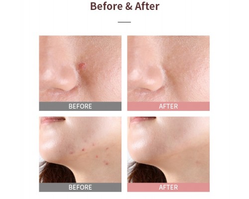 Trattamento spot rosa Good Bye Blemish Mizon