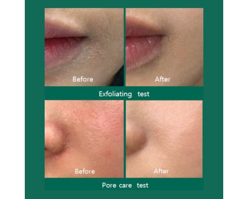 Toner in mist corpo agli acidi AHA, BHA e PHA contro acne 30 Days Miracle Some By Mi