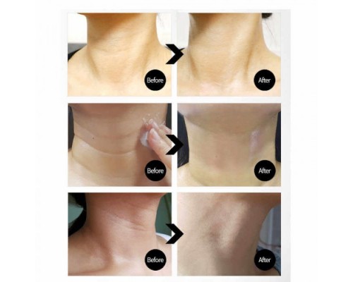 Crema premium collo e zona décolleté al collagene Thread Naite 2.0 100 ml Medi-Peel 